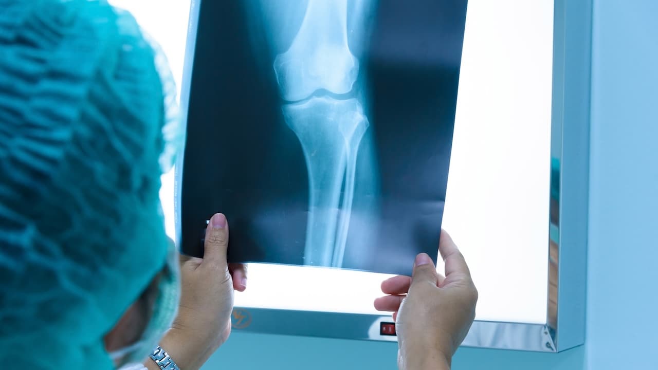 Ärztin, die vor der Behandlung mit dem Knie auf ein Röntgenbild blickt. Knochenbild in der orthopädischen Abteilung im Krankenhaus.